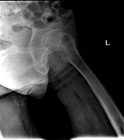 E:病历资料THA王金兰全髋DR73866DR73866_1.jpg