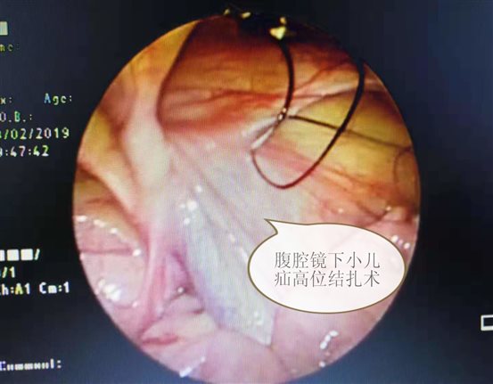 小儿疝