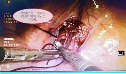 精索静脉高位截肢
