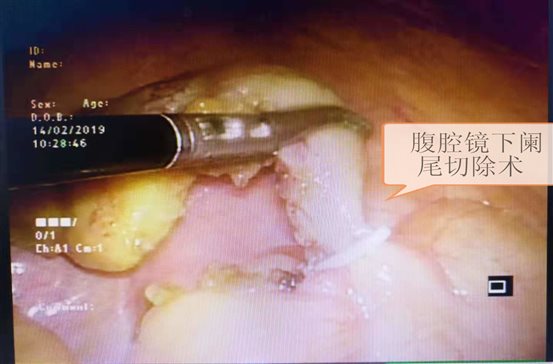腹腔镜下阑尾切除术