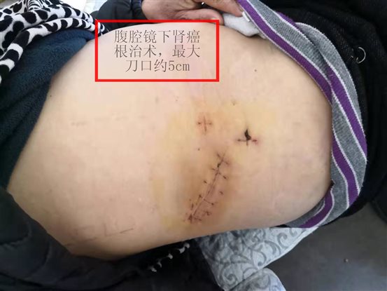 肾癌根治术