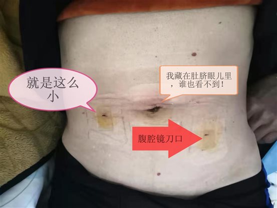 腹腔镜刀口_看图王