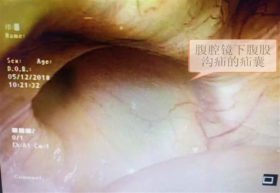 腹股沟疝